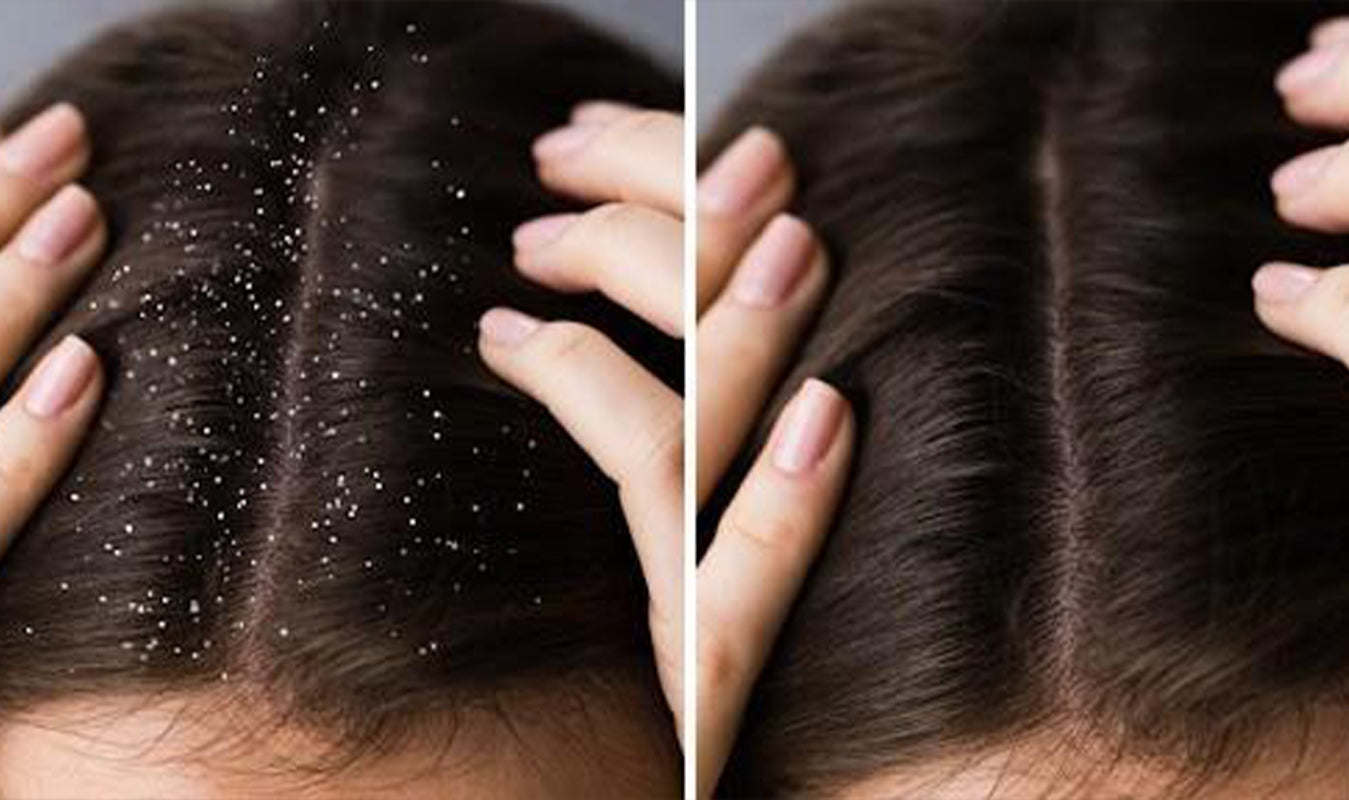 Best ways to avoid dandruff in hair